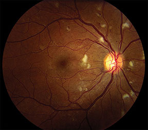 Severe NPDR with cotton-wool spots, intraretinal hemorrhage and IRMAs