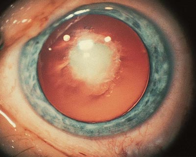 Congenital cataract (a cataract present at birth).