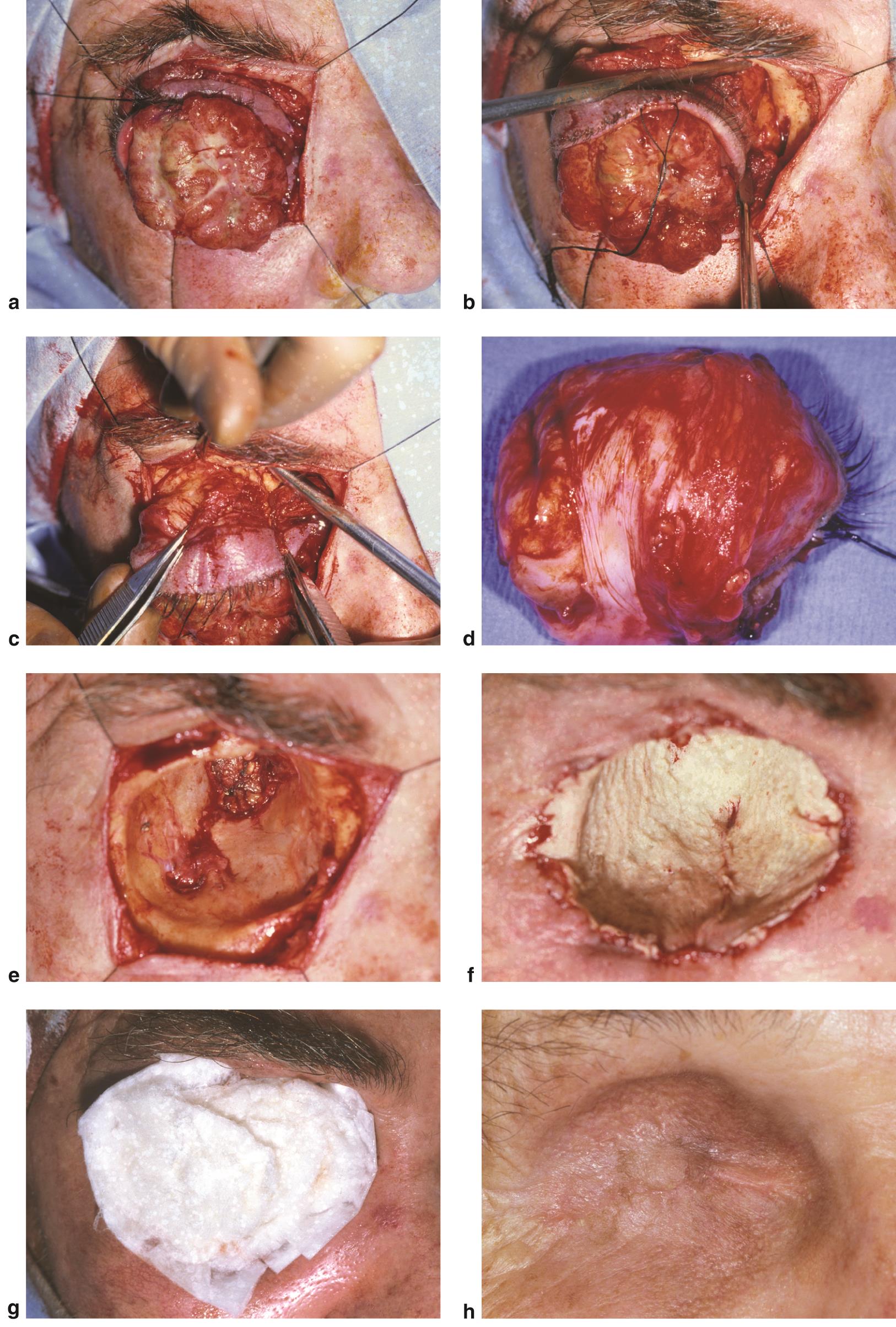 Steps in exenteration surgery - American Academy of Ophthalmology