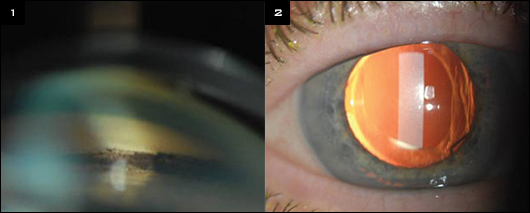 Secondary Glaucoma From Single-Piece IOLs