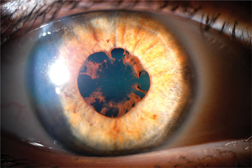 Anterior Segment of the Right Eye