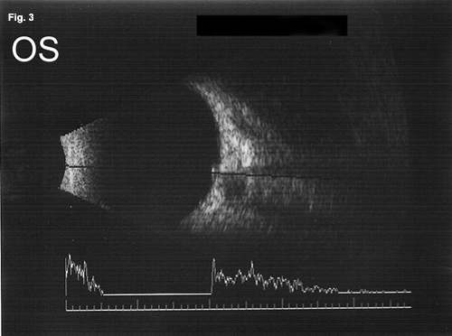 B-Scan Ultrasonography 3