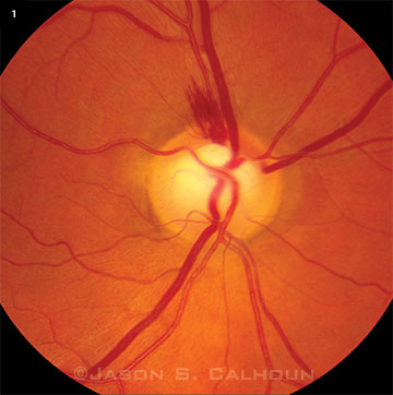 Disc Hemorrhages in Eyes With Glaucoma