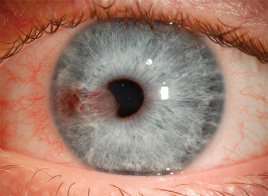 Vascularized iris cysts viewed with diffuse illumination