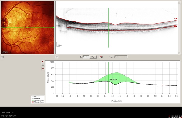 OCT image of case 5 showing the change in macular thickness from baseline in green shadowing.