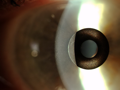 Kamra inlay implanted in the cornea