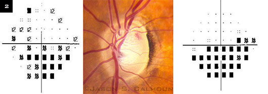Disc Hemorrhages in Eyes With Glaucoma