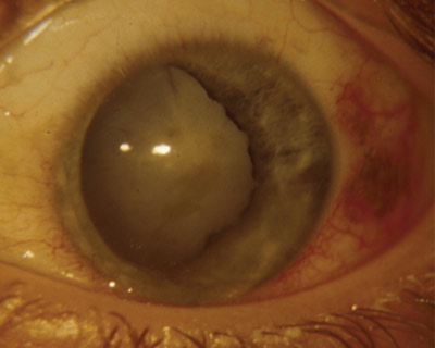Traumatic cataract caused by injury to a child's eye.