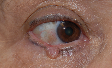 Basal Cell Carcinoma American Academy Of Ophthalmology