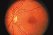 A normal retina