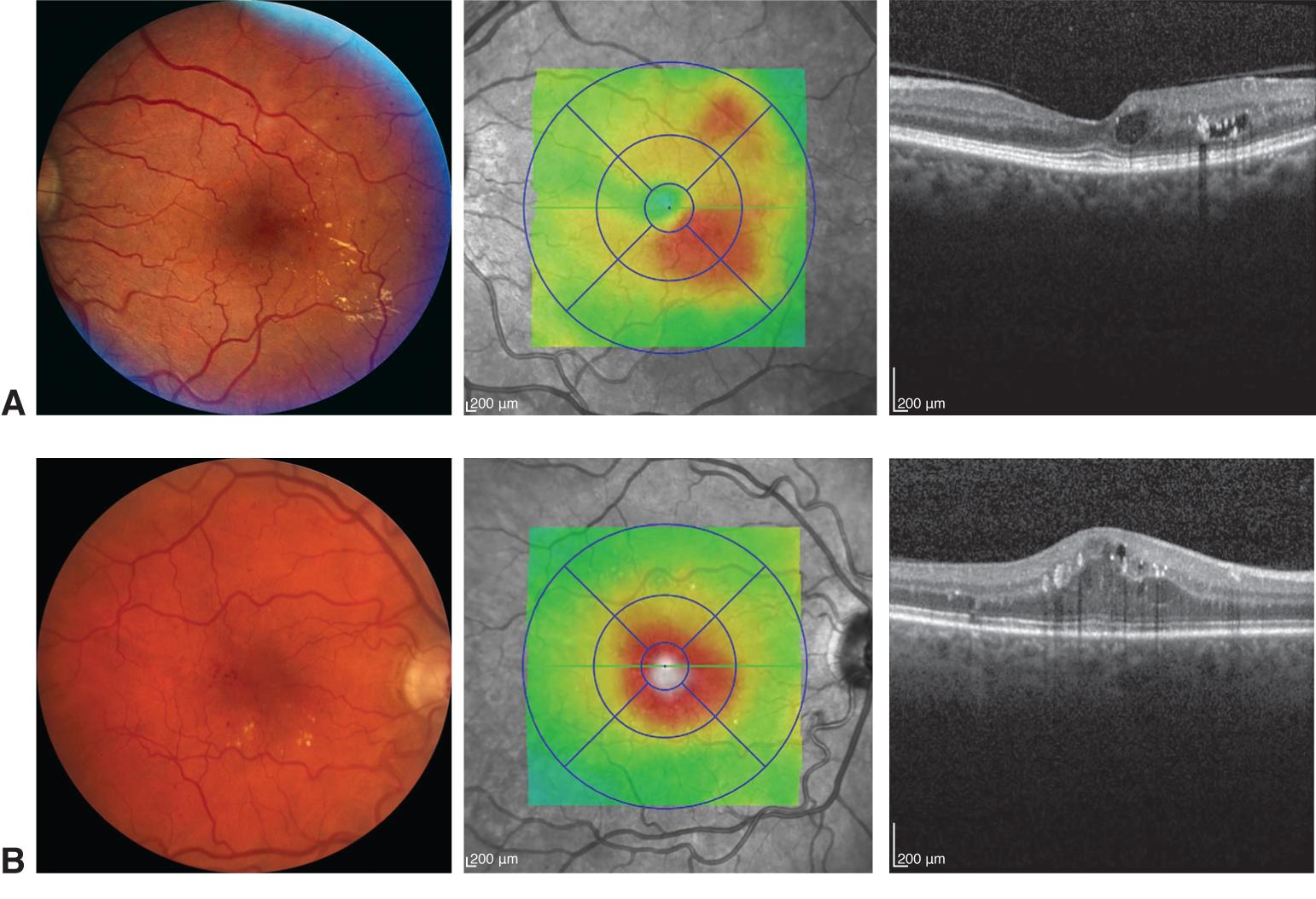 research articles on diabetic macular edema