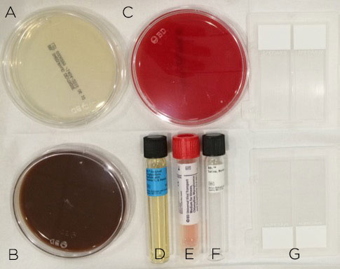 Figure 4. Corneal scraping should be
prepared on the appropriate culture
media: Saboraud agar (A) for fungal
culture; chocolate agar (B) for aerobes;
blood agar (C) and thioglycolate
broth (D) for aerobes and
anaerobes; viral transport media (E)
for viral and Chylamydia culture and
sterile saline (F) to transport specimens
that require plating in the lab
with otherwise unavailable media.
Glass slides (G) should be used to
create smears for microbial stains.