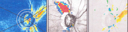 Images from another glaucoma patient OD. L to R: GDx image; deviation map; difference from baseline.