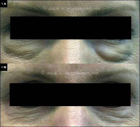 Patient With Visible Nodules Following Soft Tissue Filler Injection