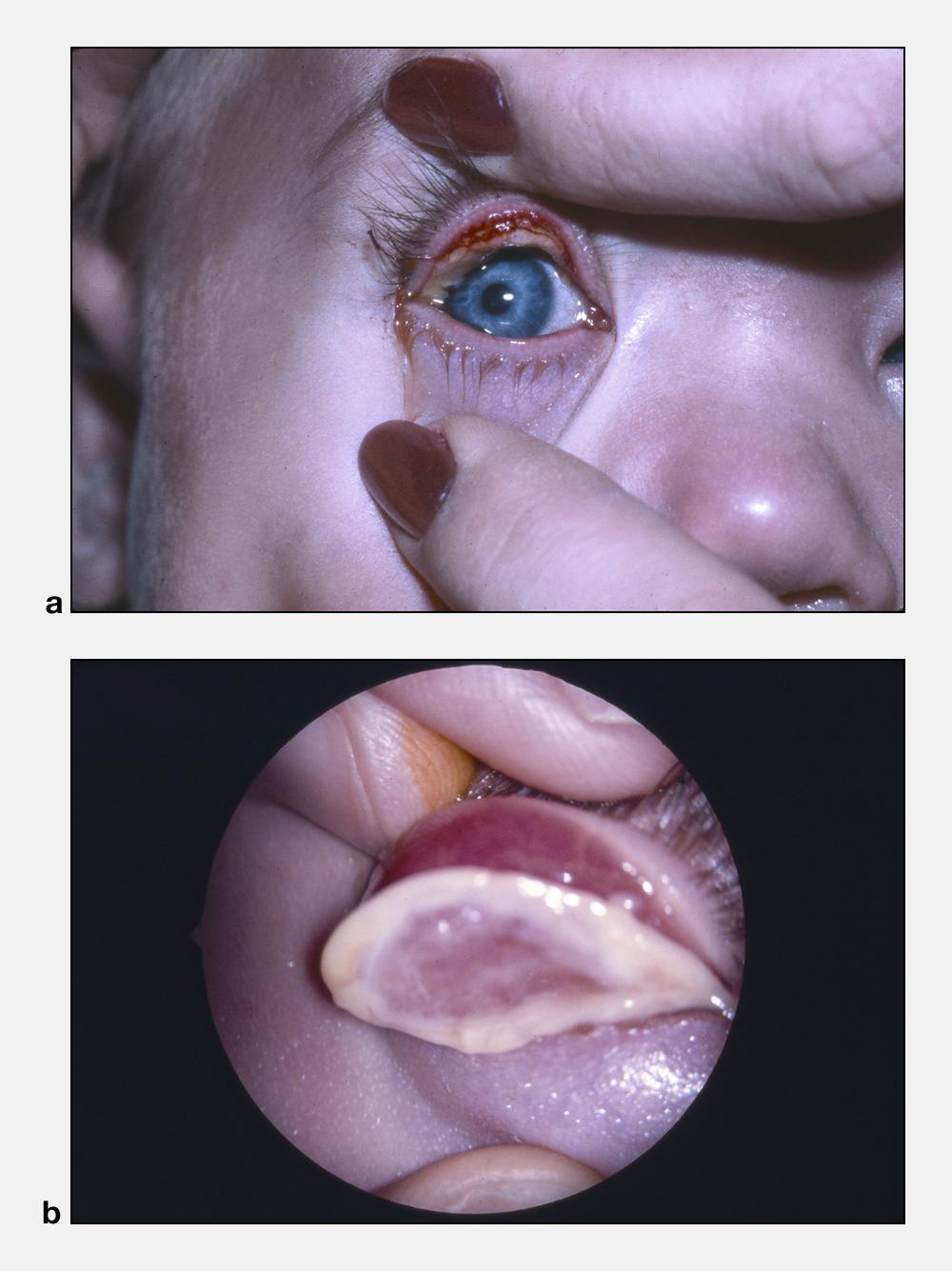Ligneous conjunctivitis - American Academy of Ophthalmology