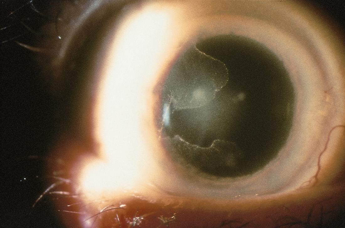 Corneal intraepithelial neoplasia - American Academy of Ophthalmology