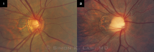 Optic nerve appearance of two highly myopic patients: (1) diagnosed with glaucoma; (2) without glaucoma.