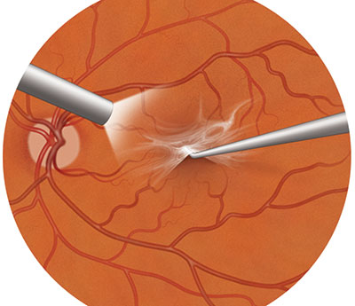 Illustration of macular pucker surgery, where an ophthalmologist uses tiny instruments to remove the wrinkled tissue, or macular pucker, inside the eye.