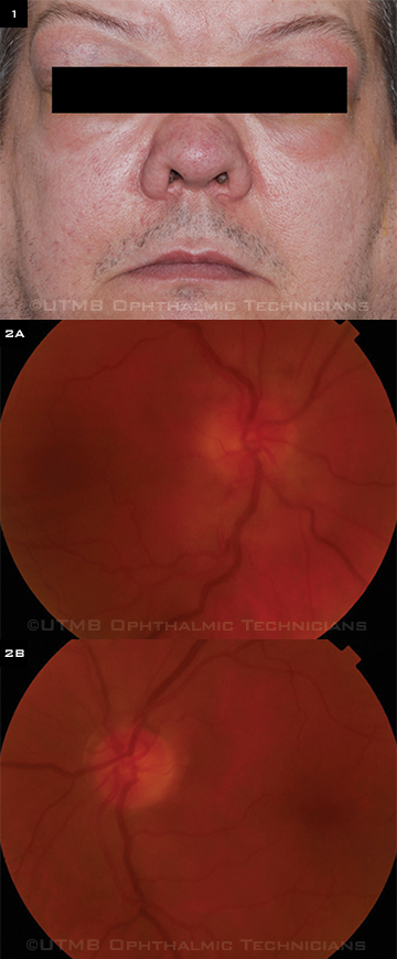 Juvenile Open-Angle Glaucoma