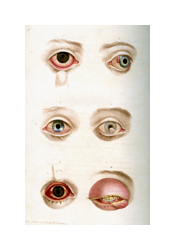 An colored illustration of six diseased human eyes. From top the bottom, the eyes get progressively more red, and the last eye is extremely red and the eyelids are swollen shut.