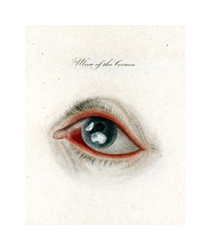 A colored illustration of a diseased human eye. The eye has a blue iris, but there are several white spots across the front of the eye. The eyelids are swollen and bright red.