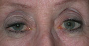 Ptosis in an adult
