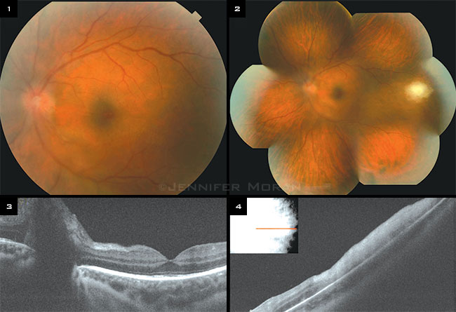 Syphilitic Panuveitis and Retinitis in HIV