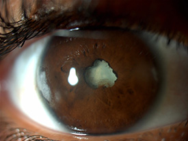 Posterior synechiae and a dense cataract in a HLA B27 positive patient. Photo courtesy of Dr. Lee.