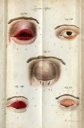 A page from a book with hand drawings of different diseased human eyes. The drawings show the inside and outside of a person's swollen red eyelid. The severity of swelling and redness changes from picture to picture.