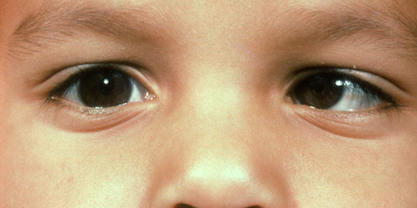 Niño que se está examinando con la prueba de reflejo de luz corneal. Los reflejos de luz asimétricos en los ojos, muestran que es posible que el niño tena