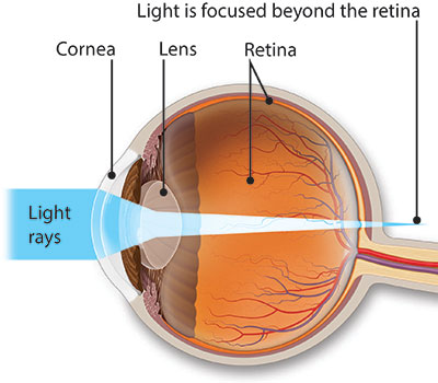 Profile view of an illustrated eye showing how light rays falls beyond the retina of a farsighted eye