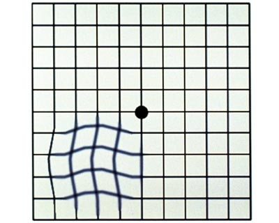 Rejilla de Amsler con líneas onduladas, como podría ser visto por alguien con pérdida de visión