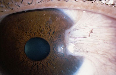 Photograph of a pterygium (surfer's eye), a fleshy growth on the eye