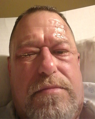 Jeff Strayer recovers in the hospital after treatment for a chemical burn to his eyes.