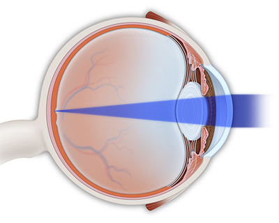 Un ojo que enfoca la luz correctamente en la retina