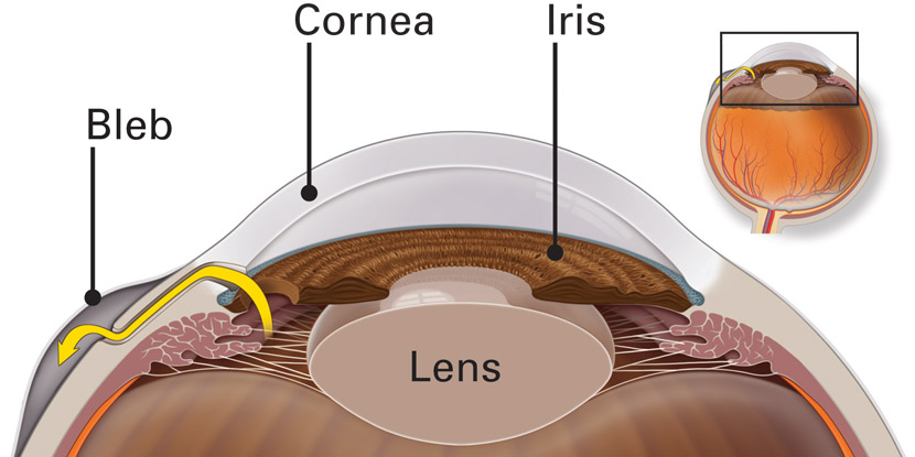 Illustration of a trabeculectomy, when a surgeon creates a tiny flap in the white of your eye to lower intraocular pressure from glaucoma