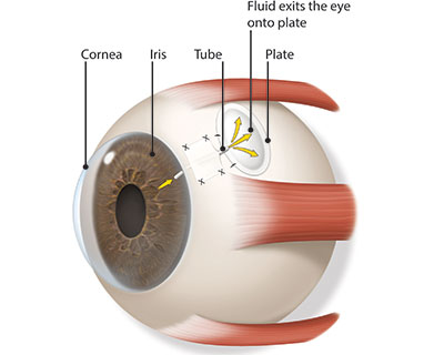 Image of aqueous fluid exiting eye onto the implant plate on white of eye