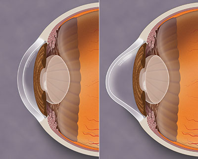 Side-by-side, profile-view illustration of a healthy cornea and one with keratoconus