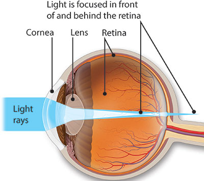 Illustration of an astigmatic eye with light rays landing in front of and behind the retina.