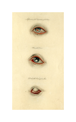 Three colored illustrations of a diseased human eye. The top eye has a red spot across the iris. The middle eye has a large white spot in the middle of the eye. The bottom eye is milky and white and has red, swollen eyelids.