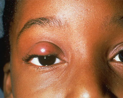 Photograph of a chalazion on a young woman's right upper eyelid