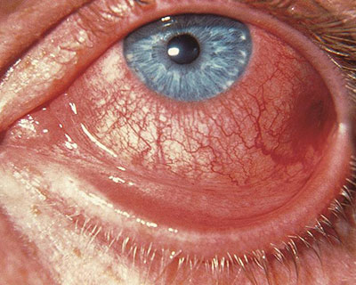 A red, inflamed eye suffering from viral conjunctivitis