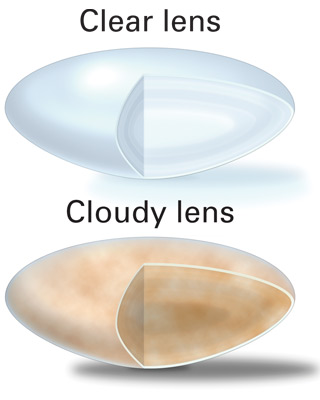 The definition of a cataract is a cloudy lens in the eye, whatever the cause may be. Here the cataract lens is compared to a natural clear lens.