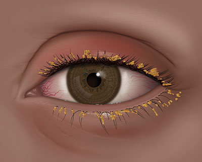 An illustration of blepharitis, where the eyelids become coated with oily particles and bacteria near the base of the eyelashes