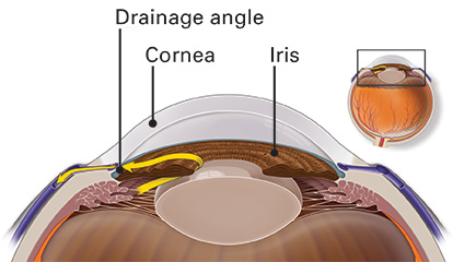 Illustration of the drainage angle in a healthy eye. The iris does not prevent fluid from draining out of the eye.