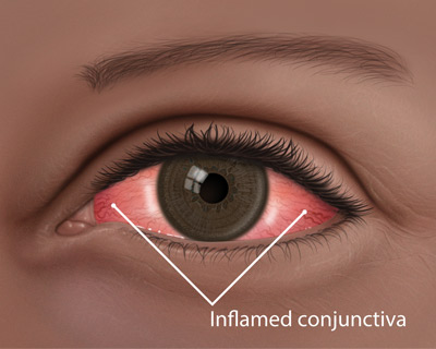 Inflamed conjunctiva of pink eye