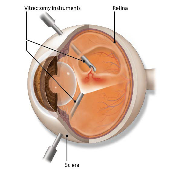 Illustration of vitrectomy surgery. Vitrectomy is a type of eye surgery used to treat problems of the eye’s retina and vitreous.