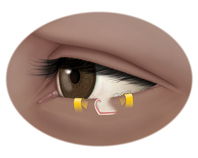 Illustration of lower eyelid with entropion, or lower eyelid that turns inward