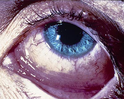 Inflammation from allergic conjunctivitis