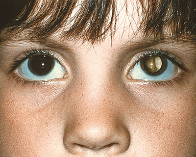 Photograph of a child showing an abnormal white eye reflex in the back of their eye. This can be a sign of eye disease.